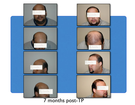 hair transplant after 7 months