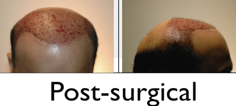 hair transplant postop