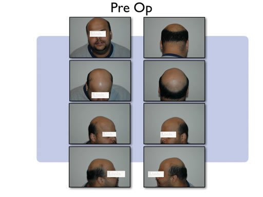 Hair transplant preop