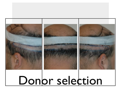 hair transplant strip